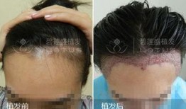 植发明星爆料视频大全,揭秘脱发困扰与美丽蜕变之路